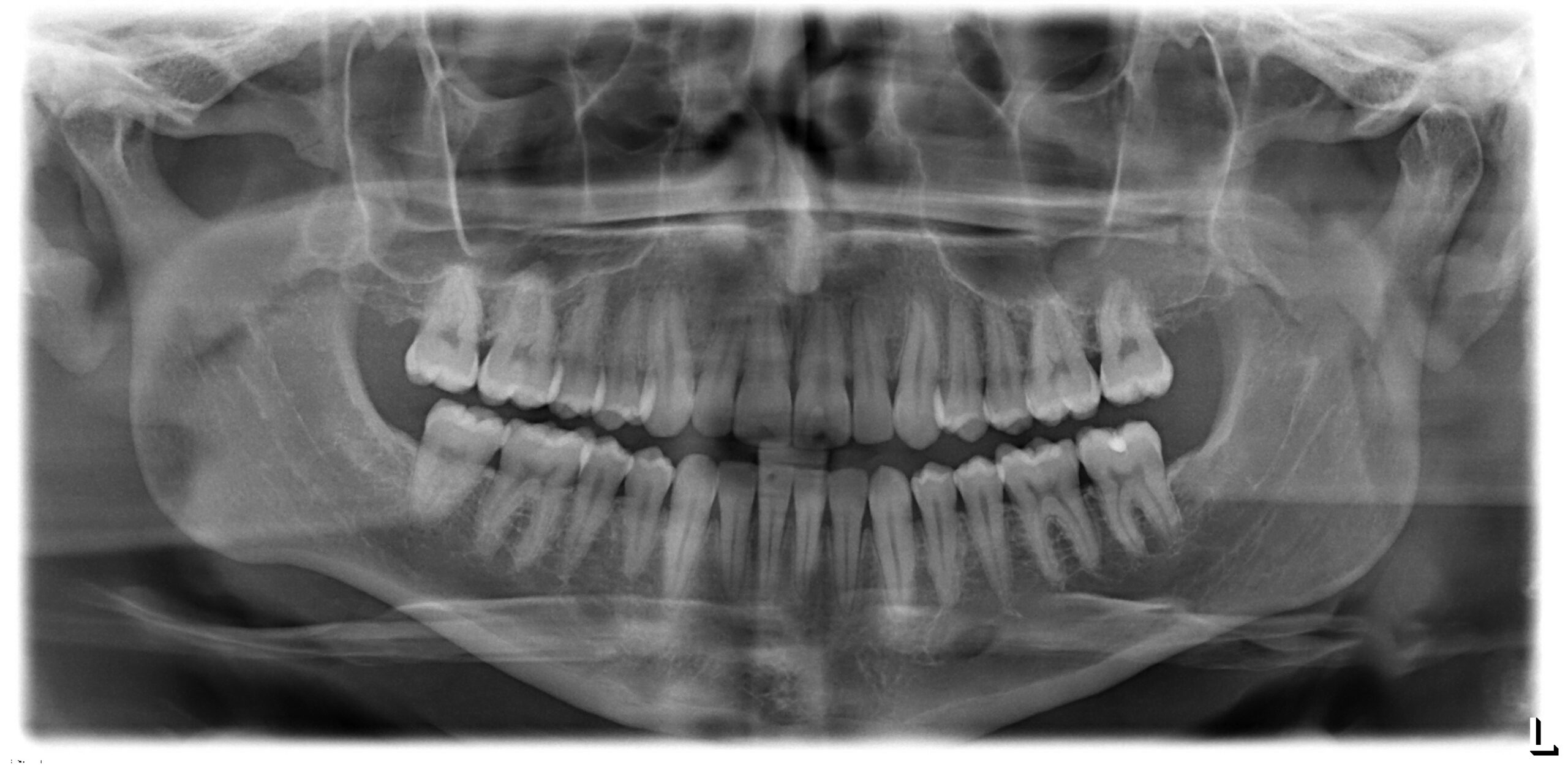 orthodontic x-rays safety